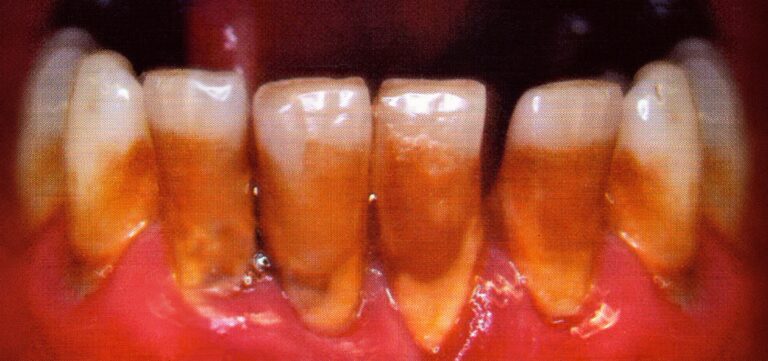 “Cigarette Teeth” - Sarah Lucas 